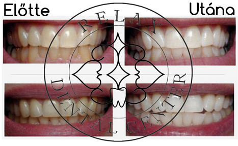 Fogfehérítés előtt és után