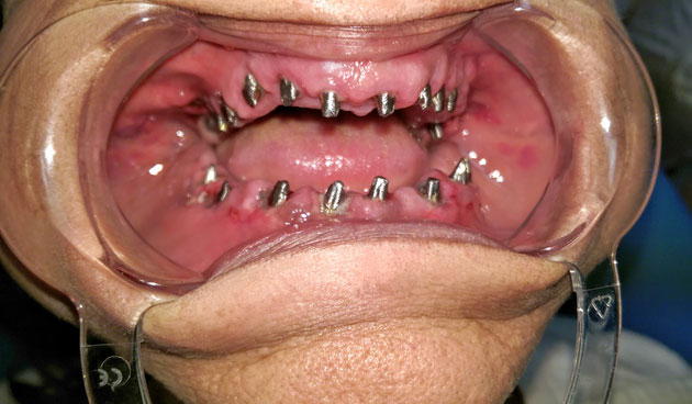 Implantátum készítése közben